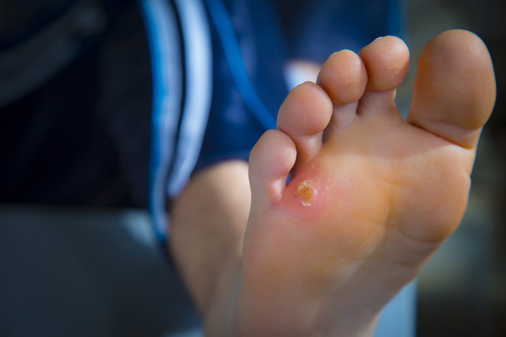 Wound Care Tarzana, CA
